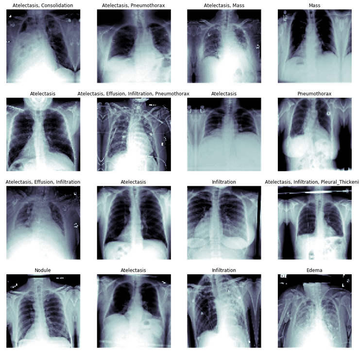 chest x-rays